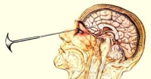 An illustration of lobotomy being performed